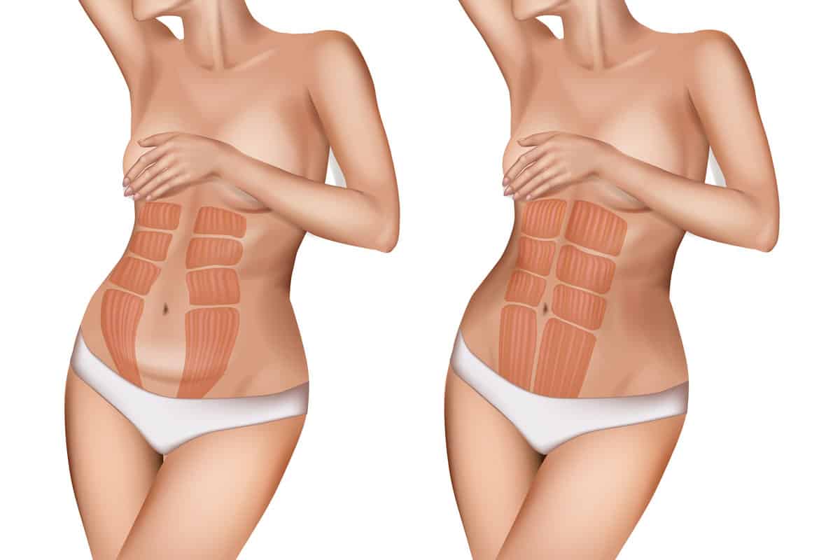 Abdominoplastia