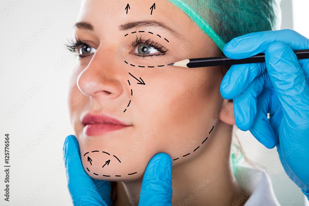 Mentoplastia