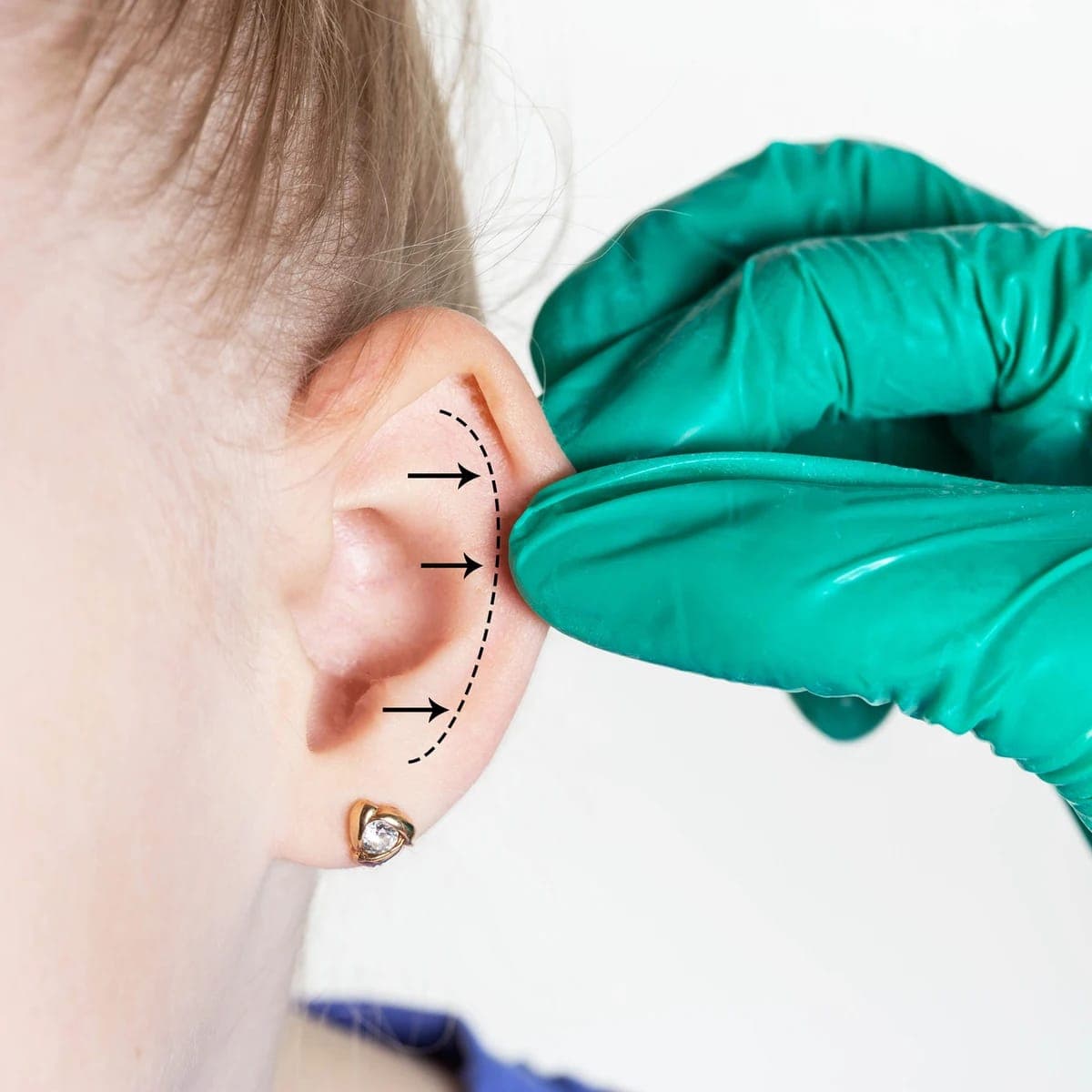 Otoplastia