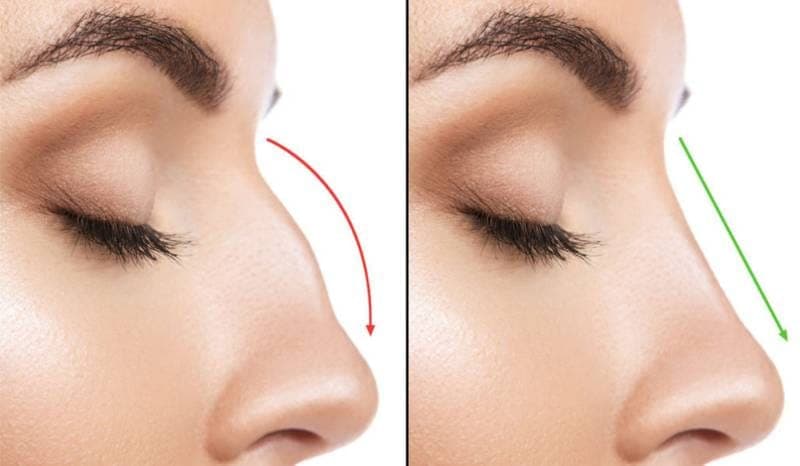Rinoplastia